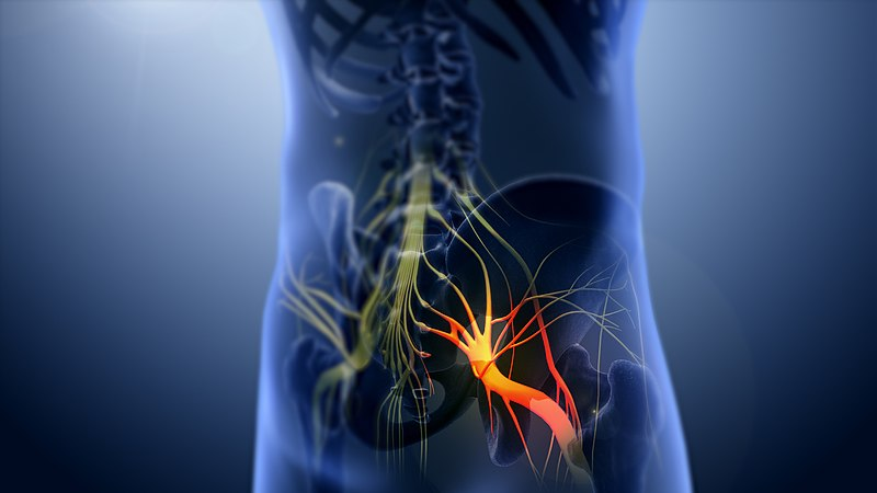 Scientific image of sciatica nerve pain